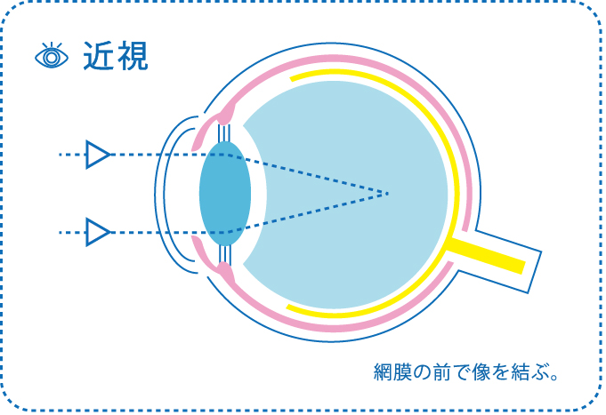 近視　イラスト