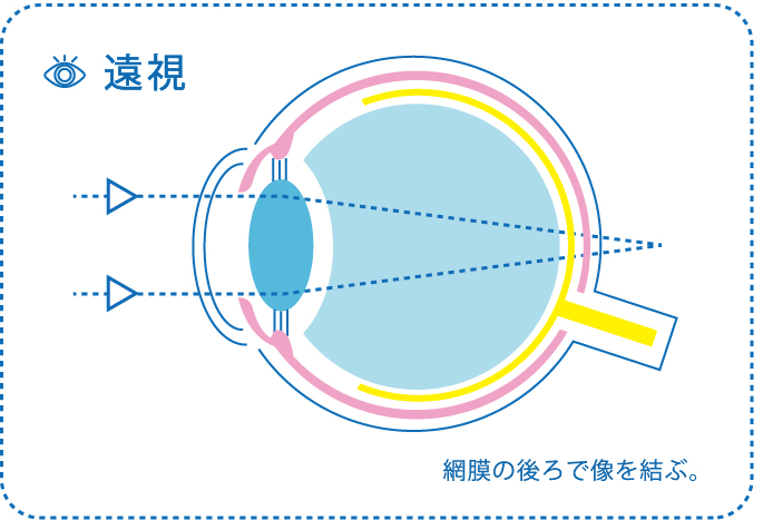 遠視　イラスト